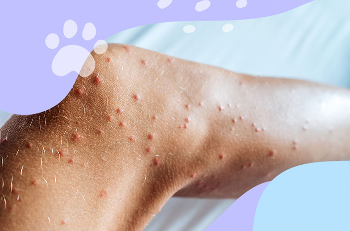 Piqûres, taches, points noirs : punaises de lit, puces ou moustiques ?